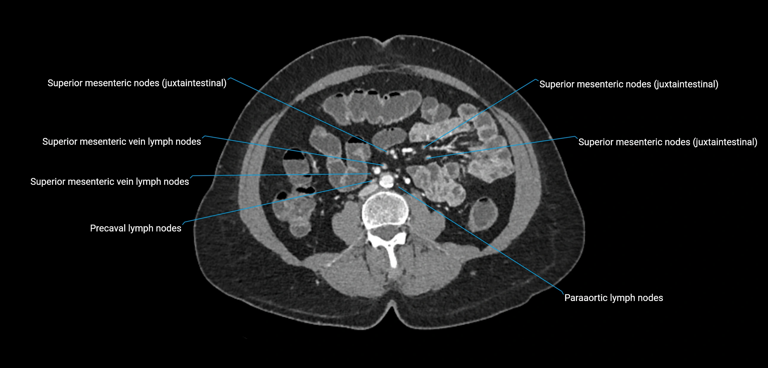 CT ct abdominal lymph nodes  axial cross sectional anatomy  enchanced radiology image -img-00002-00243.webp